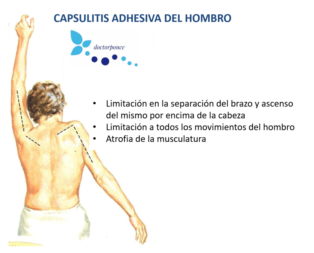Capsulitis adhesiva del hombro