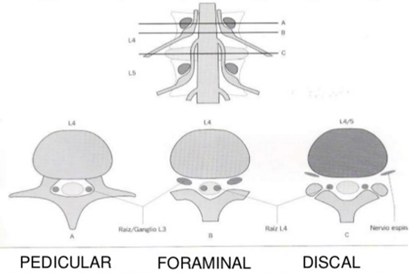 hernias discales según su nivel o altura
