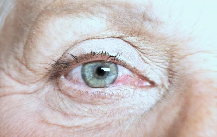 sindrome del ojo seco