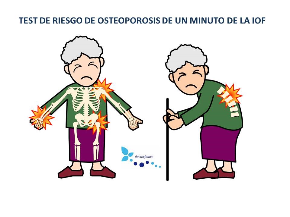 test de osteoporosis en un minuto