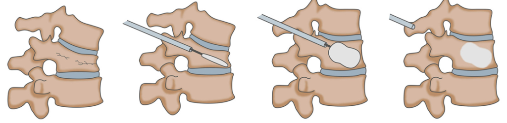 Imagen que contiene vertebra, fractura