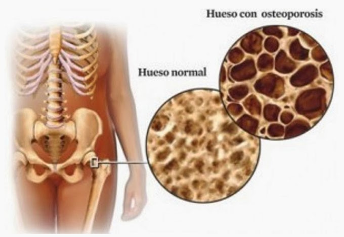 Tratamiento secuencial osteoporosis